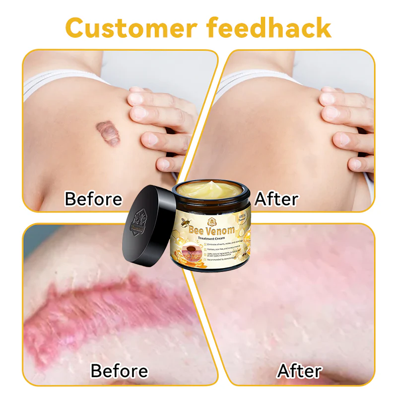 Crema para el tratamiento de la piel con veneno de abeja Turonu™ (aprobada por Health Canada)